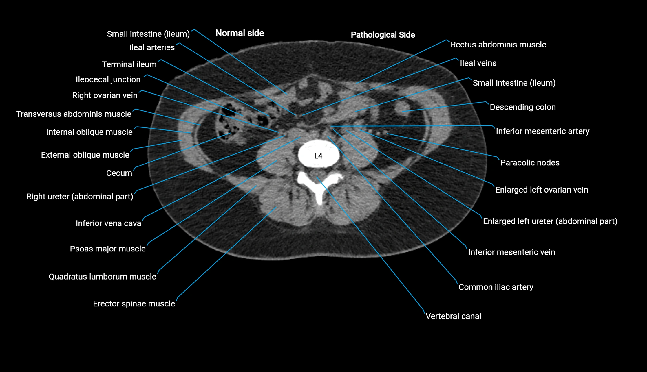 CT KUB axial cross sectional anatomy  radiology image -img-00201-00091.webp